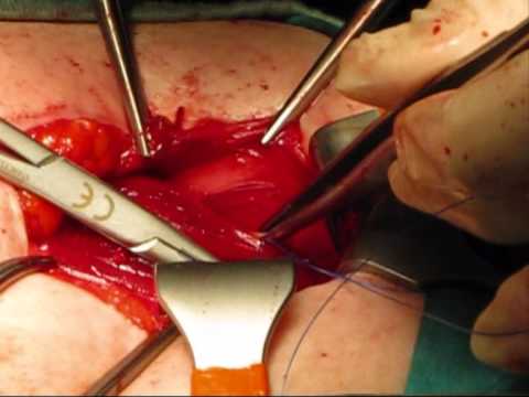 Trattamento di ernia intervertebrale del rachide cervicale Non piegare le articolazioni delle gambe
