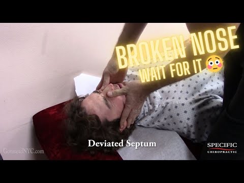 Broken Nose From a Face Fall Gets an INSANE Crack! Deviated Septum & Breathing Relief