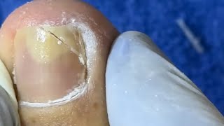 Ep_8692 Ingrown toenail removal 👣 มีหนังอีกชิ้นนึง..ต้องเอาออก 😅 (clip from Thailand)