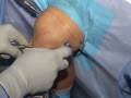 ACL Reconstruction Surgical Technique ACL Reconstruction Surgical Technique