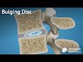 Bulging Disc