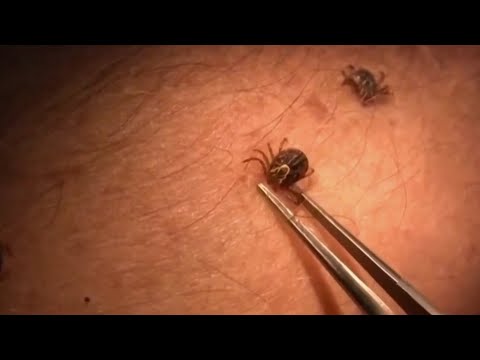 Here's what you should do if you've been bitten by a tick