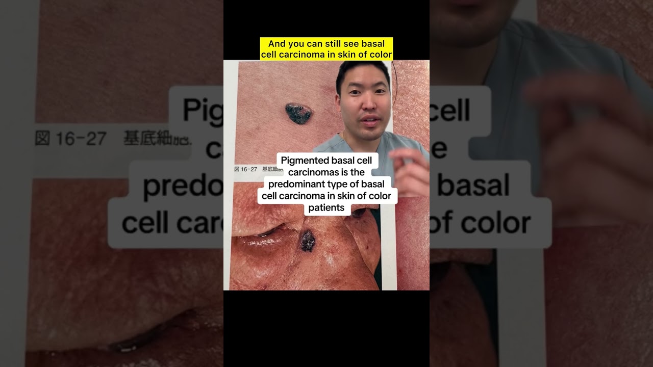 Dermatologist Explains: The Most Common Skin Cancer- Basal Cell Carcinoma