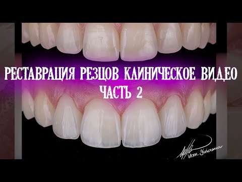 Реставрация фронтальных зубов. Клиническое видео. Часть 2