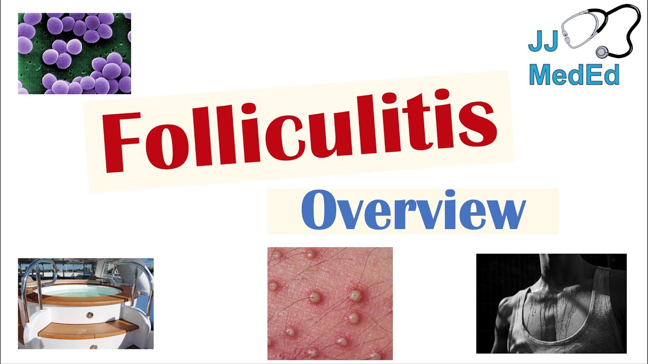 Folliculitis | Causes (Bacterial, Fungal, Viral), Risk Factors, Symptoms, Diagnosis, Treatment