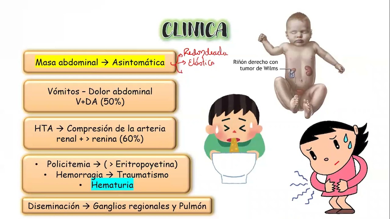 TUMOR DE WILMS - SCIEMVE