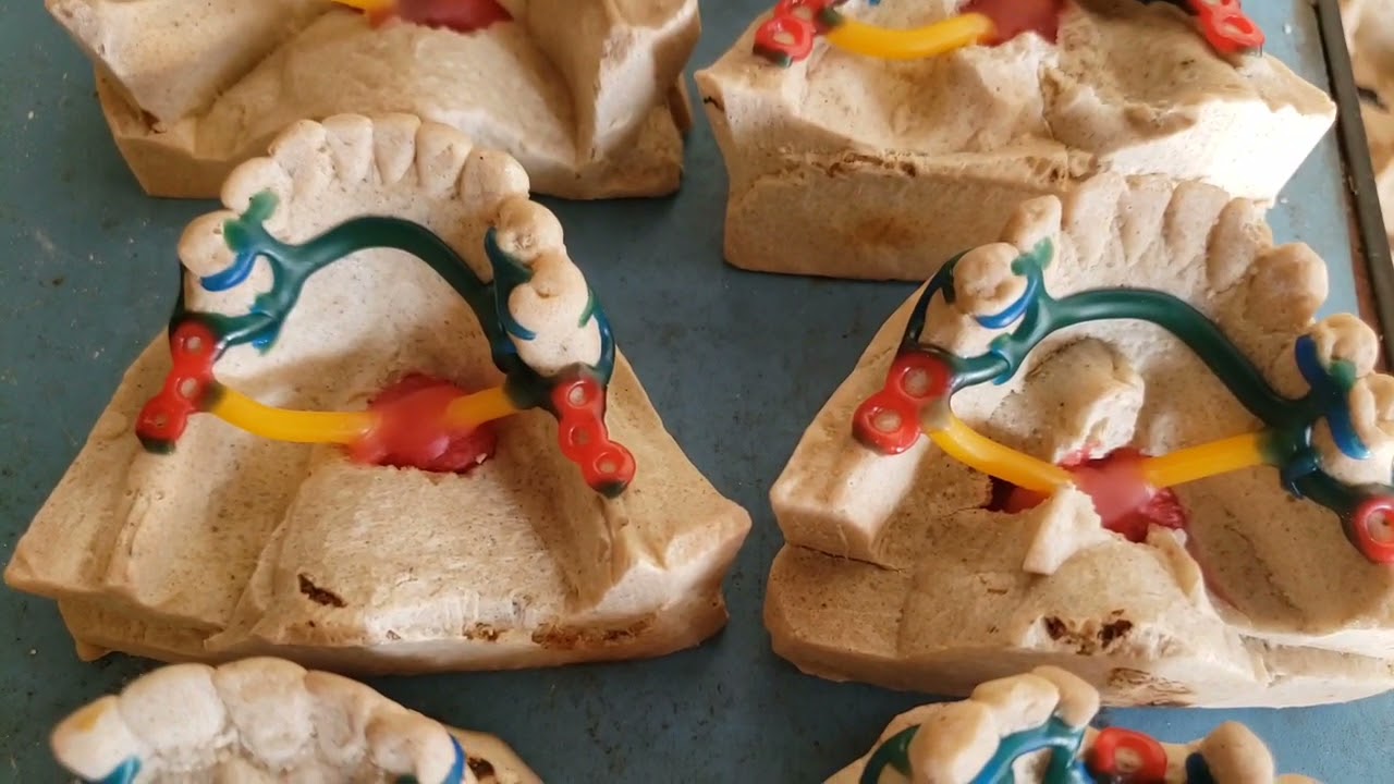 Confecção de estrutura metálica para Prótese Parcial Removível