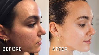 HOW I CLEARED MY ACNE (before & after pics, post-birth control syndrome & using tretinoin) | 2023