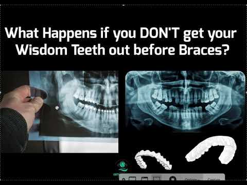 YouTube video about: How long after wisdom teeth removal can I get invisalign?