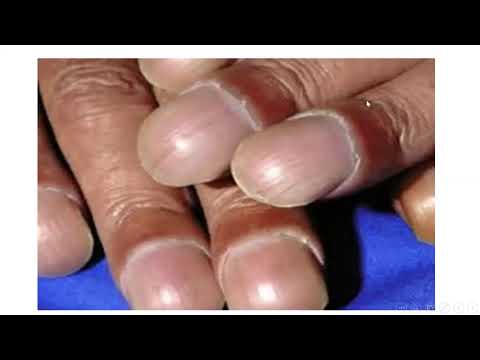 Bronchiectasis and Lobectomy