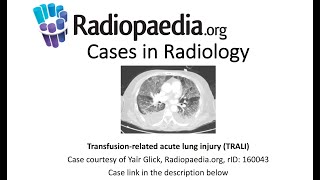 Download lagu Transfusion-related acute lung injury (TRALI) (Radiopaedia.org) Cases in Radiology mp3