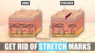 How to get rid of stretch marks fast at home permanently - Stretch marks removal