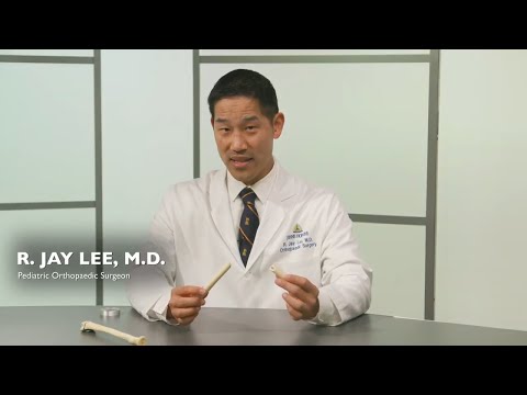 Pediatric Bone Fractures Q&A