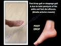 Foot Drop Slap Gait Steppage Gait