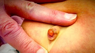 UNUSUAL GROWTH ON INFANT BELLY BUTTON (Umbilical Granuloma) | Dr. Paul