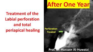 Perforation and large periapical lesion treated.