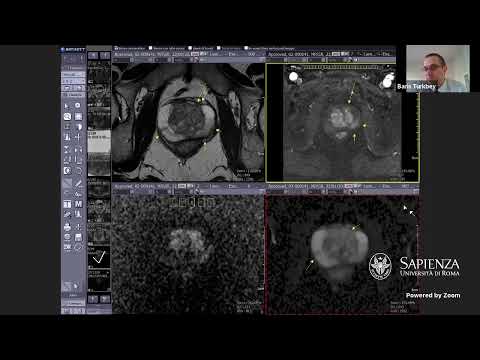 1st Flash Round on Prostate MRI