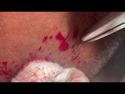 Surgical FUE Hair Transplantation Technique In South India- Part 2