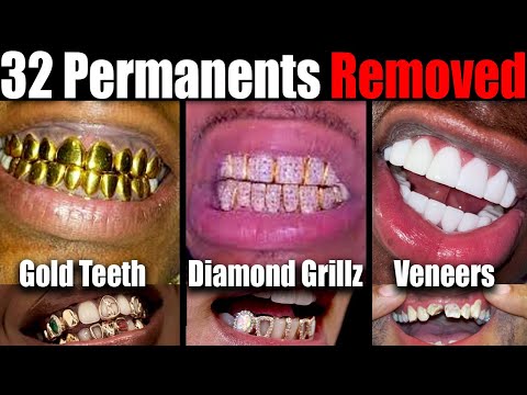 32 Permanent Gold Teeth Removed After 20 Years, The Effects Of Permanent Grillz