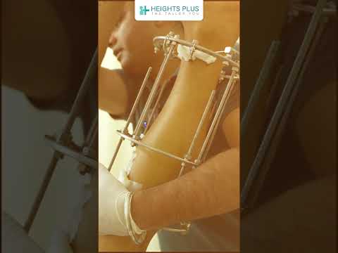 Heights Plus Patient Success Story YouTube Short Cover