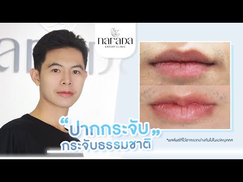 หันมุมไหนก็ยิ้มได้อย่างมั่นใจ ทรงปากสวยดูเป็นธรรมชาติ ด้วยปากกระจับถาวร ที่ นารดาคลินิก  หันมุมไหนก็ยิ้มได้อย่างมั่นใจ ทรงปากสวยดูเป็นธรรมชาติ ด้วยปากกระจับถาวร ที่ นารดาคลินิก