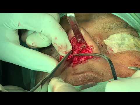Lateral Nasal Osteotomy N Spreader Grafts In Open Structure Rhinoplasty