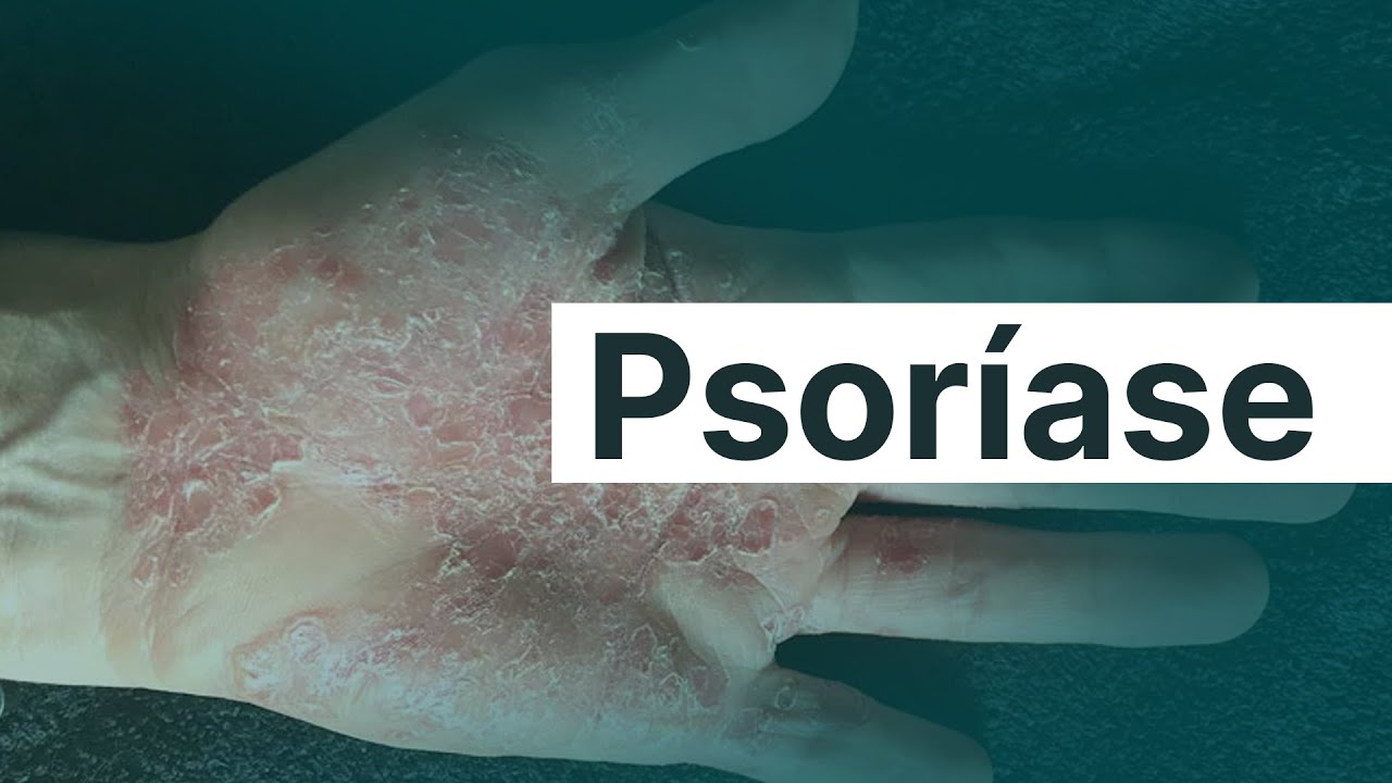 MEDICINA NA VIDA REAL: PSORÍASE | Promedicina