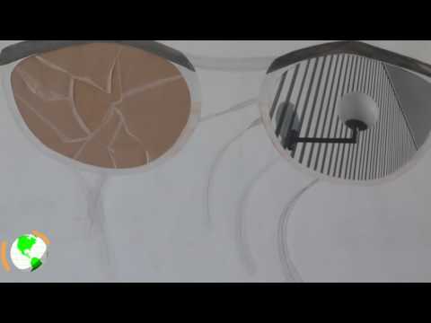 Le glaucome 1er facteur de cécité irreversible