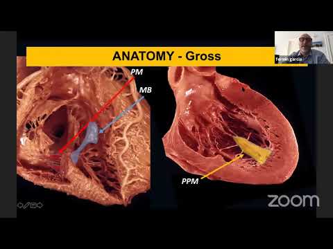 "Arritmias ventriculares de estructuras intracavitarias"