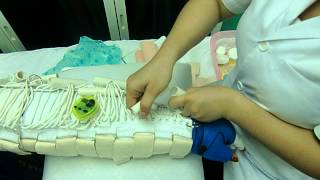 วิธีการขันชะเนาะลดบวมที่แขน Lymphedema.AVI