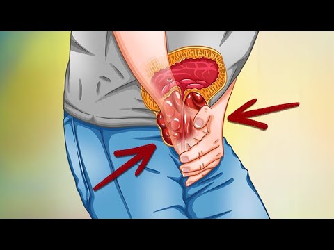 6 Lebensmittel, die man bei einer vergrößerten Prostata vermeiden sollte!