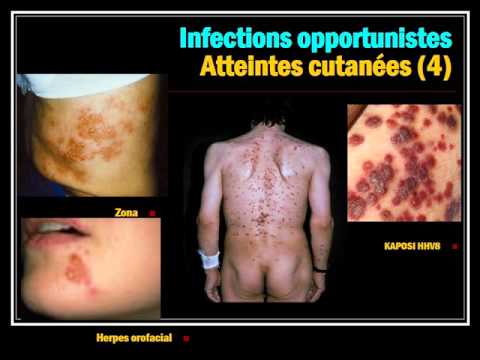 INFECTIOLOGIE INFECTION VIH 2015