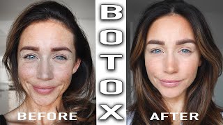 BOTOX TREATMENT BEFORE &amp; AFTER