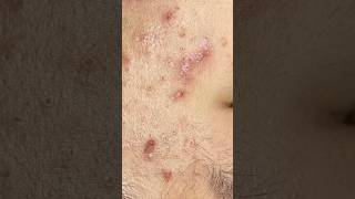 Don’t let the habit of “scratching the itch” make your skin take longer to heal! #shorts #acne