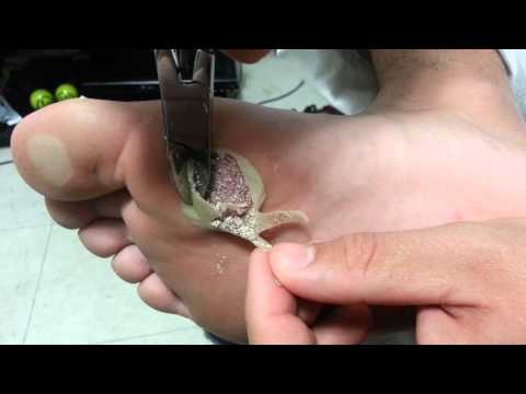 Nesterova darya tisztítás a parazitáktól