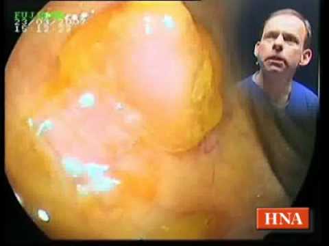 Punkte für Blutegel von Prostatitis Afarmlenne Prostan Sprachgesellschaft Schaltung