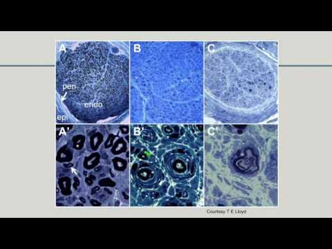 Osteocondrosi sintomi pelvici Un rimedio popolare per lhip cisti