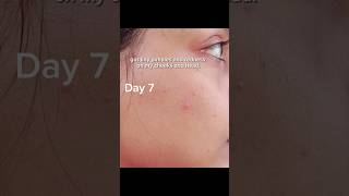 Download lagu Unexpected Rice water Results I must say🤡#youtubeshorts #acne #skincare #ricewater#ricetoner #fyp mp3 Download lagu Unexpected Rice water Results I must say🤡#youtubeshorts #acne #skincare #ricewater#ricetoner #fyp mp3