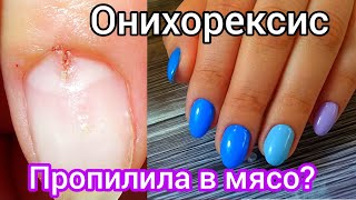 💎Онихорексис💎ПРОПИЛИЛА НОГОТЬ В МЯСО?..💎   🔴#25 #BulgakovaNails
