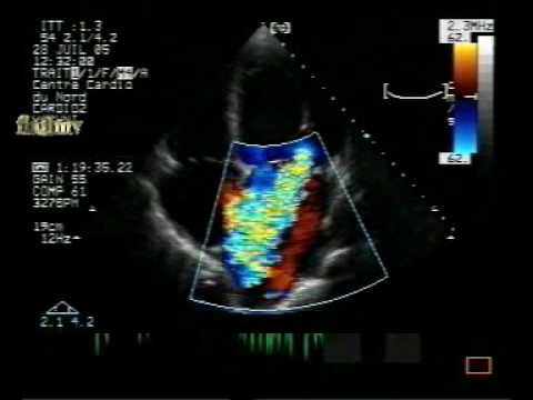 Wypadanie płatka zastawki mitralnej z ciężką jej niedomykalnością (2/2)