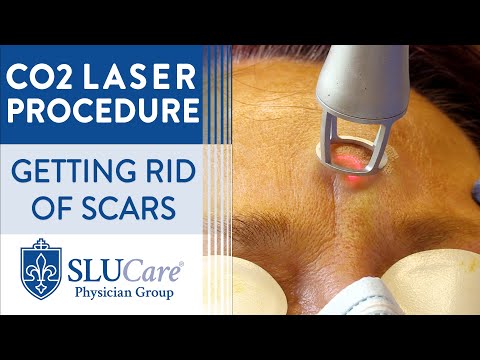 CO2 Laser Resurfacing Treatment For Getting Rid of...