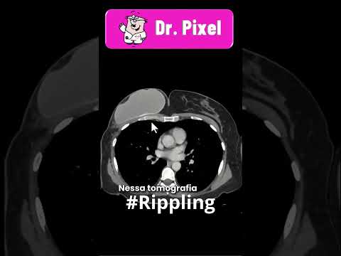 Achados do "Rippling" (ondulações ) na reconstrução mamária com próteses