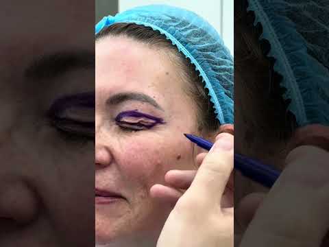 De la 0 la 3 luni de la operația de Blefaroplastie realizată de către Doctor Levy