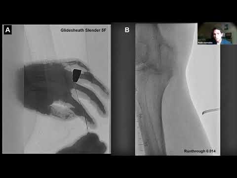 Advanced Techniques to Cross Complicated and Calcified Femoropopliteal CTOs