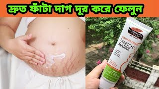 যে কোন ফাঁটা ও মাতৃত্ব জনতি দাগ দূর হবে | Beast pregnancy stretch mark Removal cream review