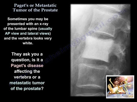 What causes enlarged prostate