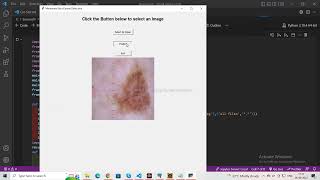 Detection of Skin Cancer Using Convolutional Neural Networks and the Tkinter Framework in Deep Learning with Python