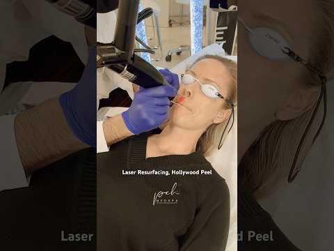 Laser Resurfacing, Hollywood Peel Laser, PCH MedSpa,...