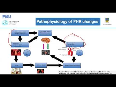 Morphological Classification Of Deceleration (CTG Part 2)