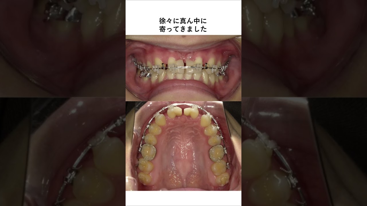 前歯の抜歯矯正 #歯医者 #矯正歯科 #歯列矯正